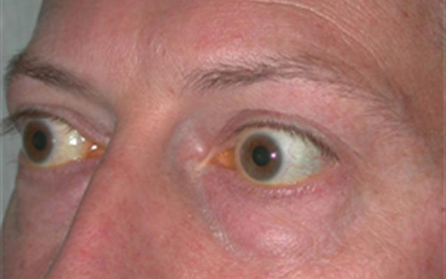 Blepharoplasty