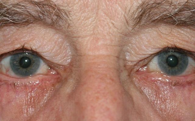 Entropian eyelids after surgery