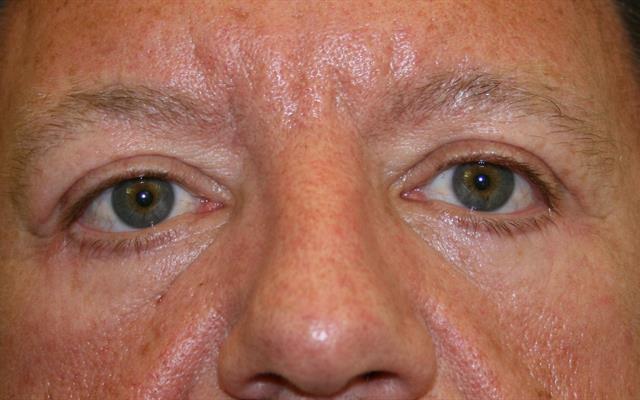 Midface Lift & Lower Eyelid Blepharoplasty after