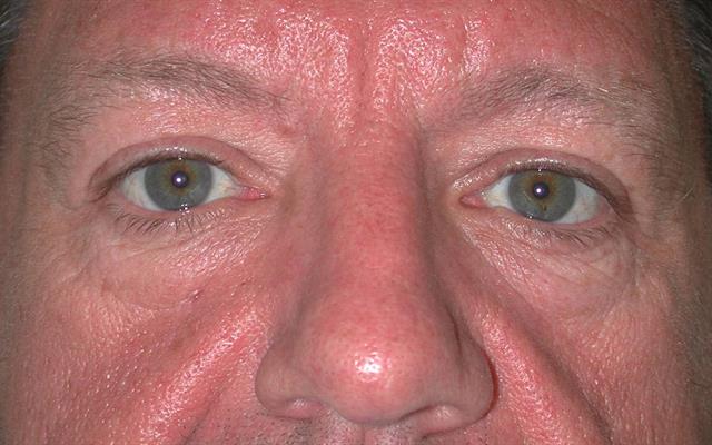 Midface Lift & Lower Eyelid Blepharoplasty before
