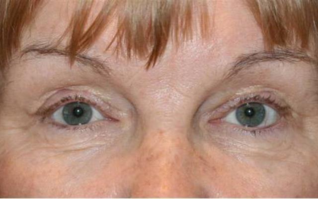 Ptosis (Droopy Upper Lids) after