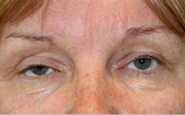 Ptosis (Droopy Upper Lids) before