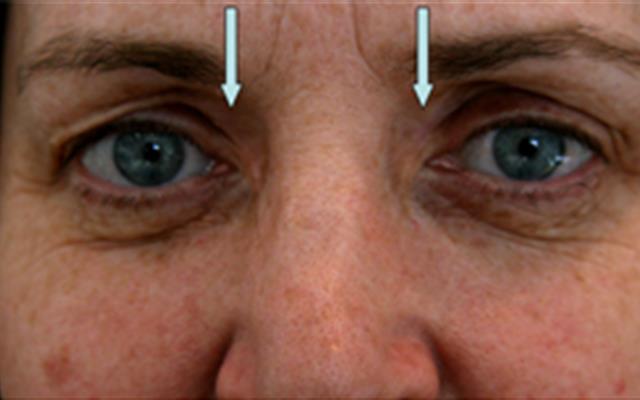 TCA Treatment For Xanthelasmata after