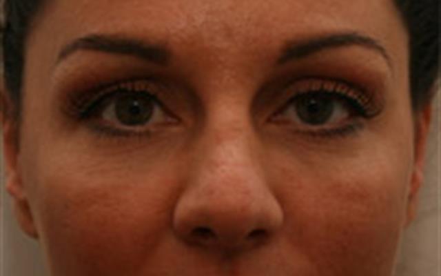 Tear Trough Rejuvenation after
