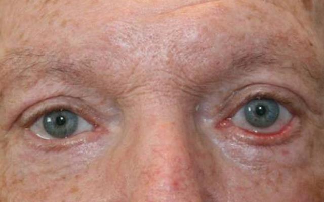 Ectropion eyelids