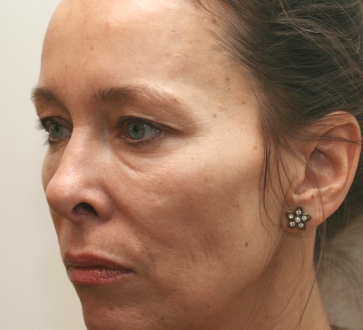 Before cheek volume enhancement using Juvéderm Voluma