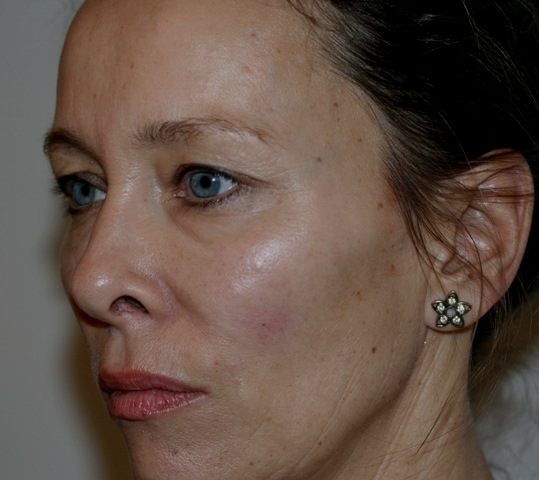 After cheek volume enhancement using Juvéderm Voluma