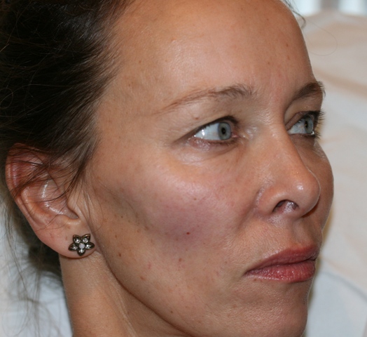 After cheek volume enhancement using Juvéderm Voluma