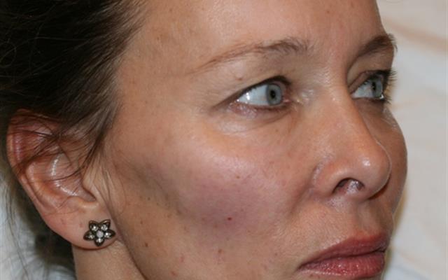 After cheek volume enhancement using Juvéderm Voluma