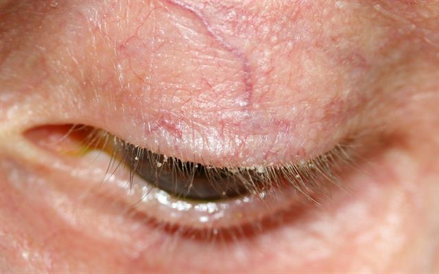 Ant Blepharitis 3