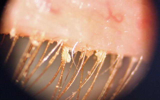 Ant Blepharitis close up