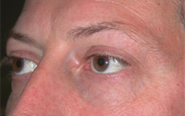 Blepharoplasty after