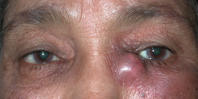 dacryocystitis