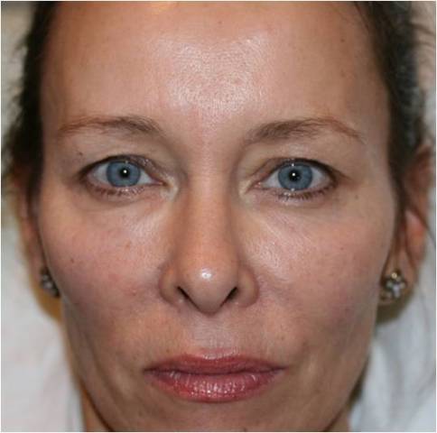 Dermal filler after