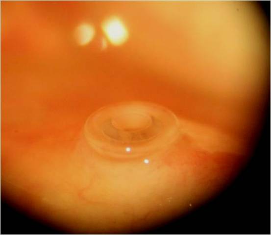 Perforated punctal plug in position