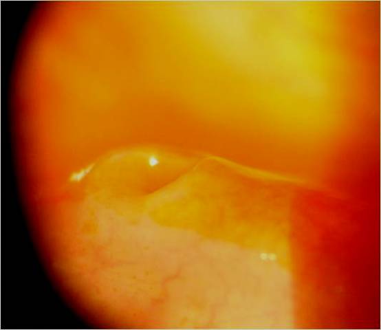 Perforated punctal plug removed